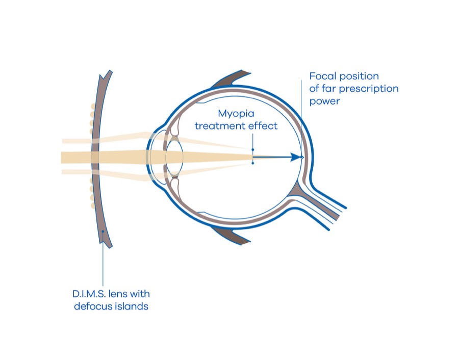 Schemat technologii D.I.M.S. w soczewkach MiYoSMART